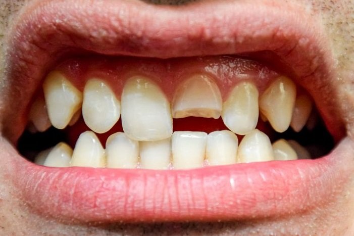 How long does it take to fix a chipped tooth